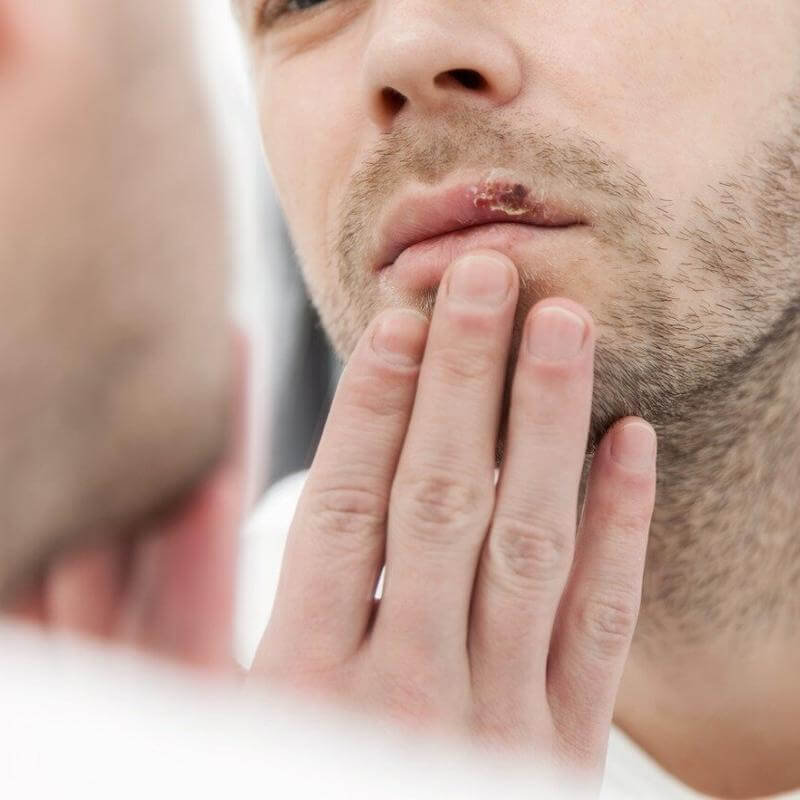 Feridas e lesões na boca: quando preocupar?