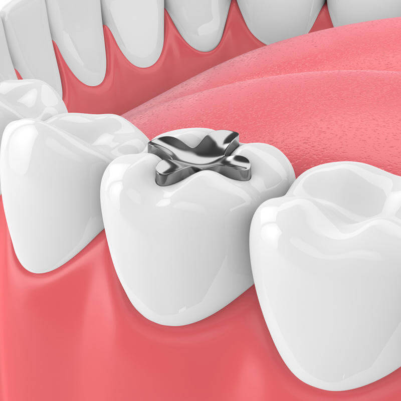 Tipos de Restaurações Dentárias