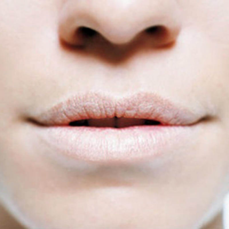 O QUE É XEROSTOMIA?