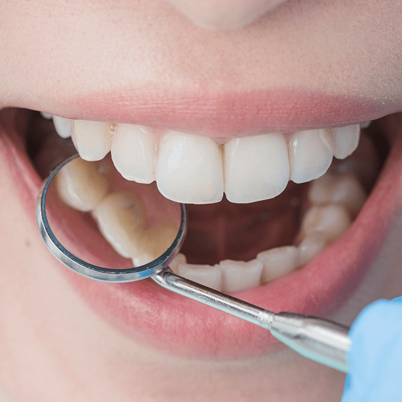 4 tipos de lesões cervicais não cariosas (LCNC)