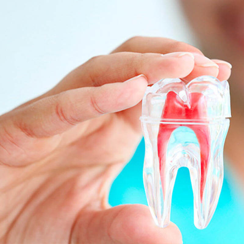 Tipos de restaurações após o tratamento de canal