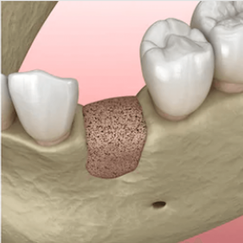 Enxerto ósseo para implante dentário