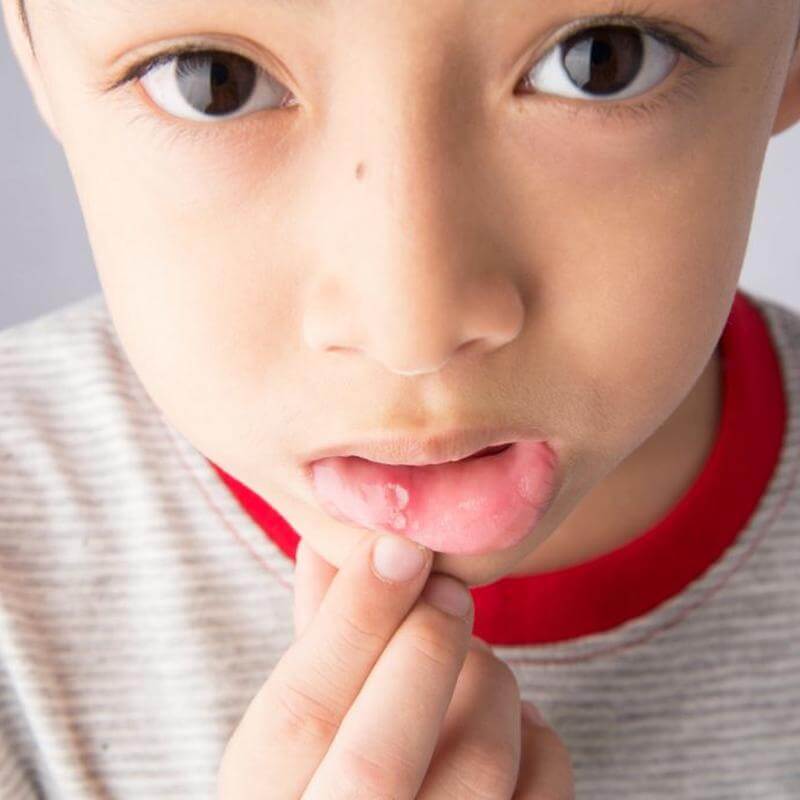 Estomatite Infantil: sintomas, tratamento e prevenção