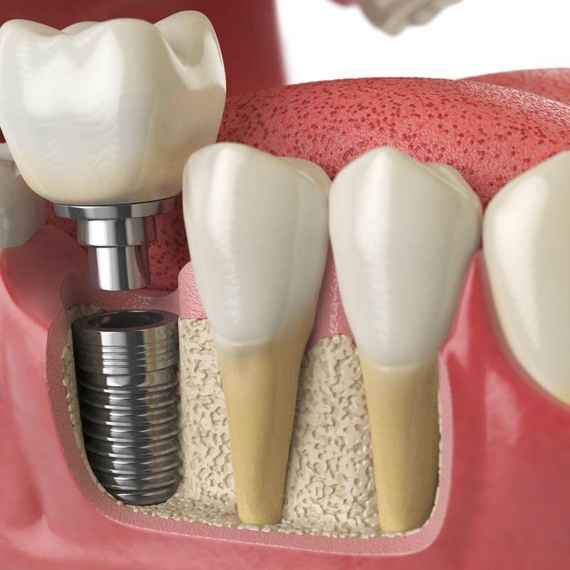 5 tipos de implantes dentários