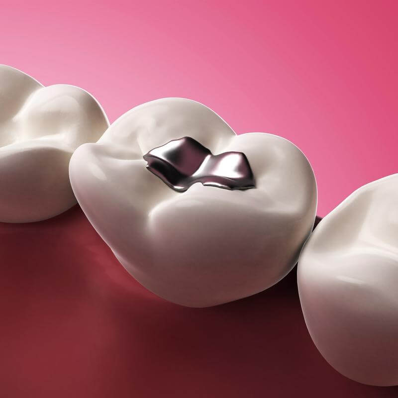 É preciso trocar as restaurações dos dentes?