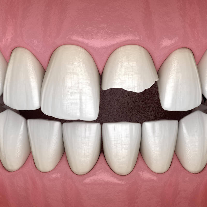 Como conservar o dente quebrado?