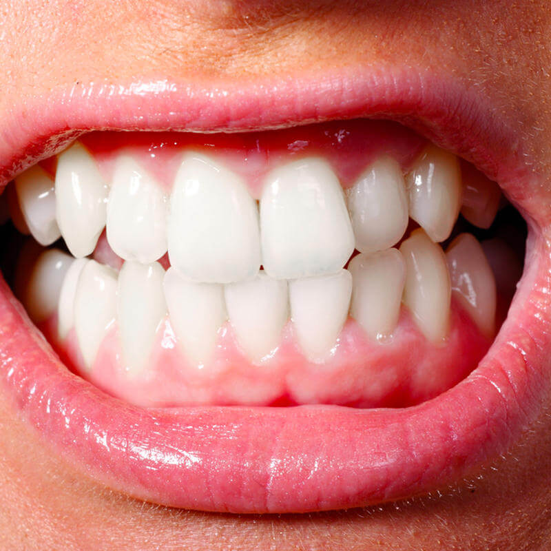 Bruxismo: causas, sintomas e tratamento.