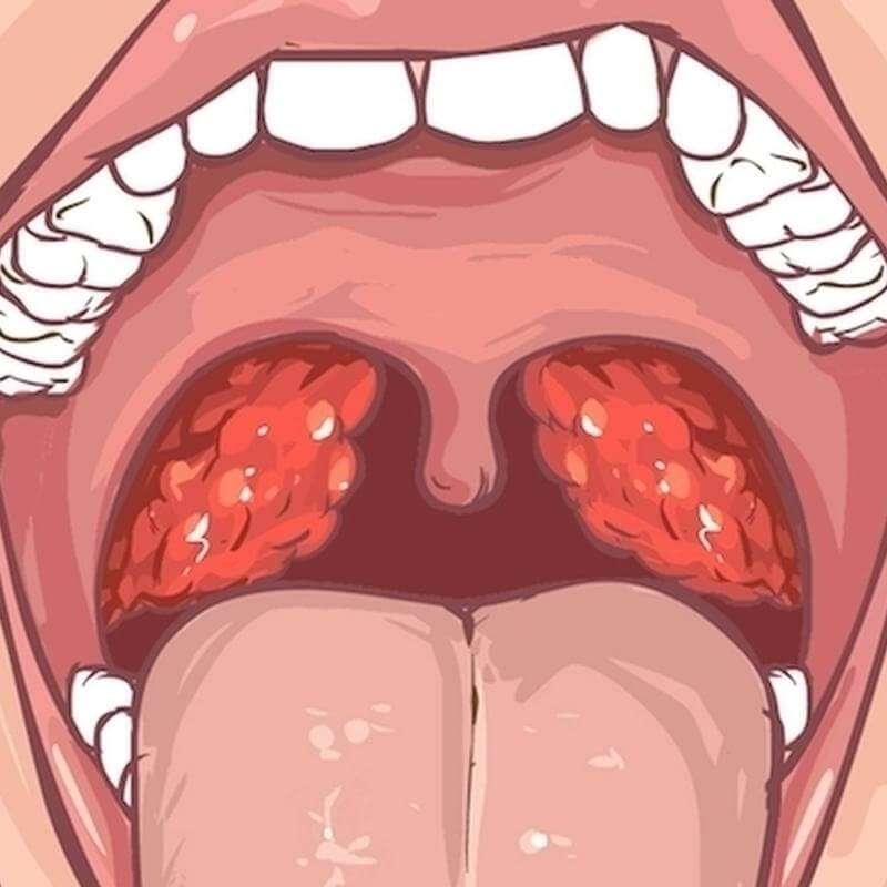 Cáseos amigdalianos