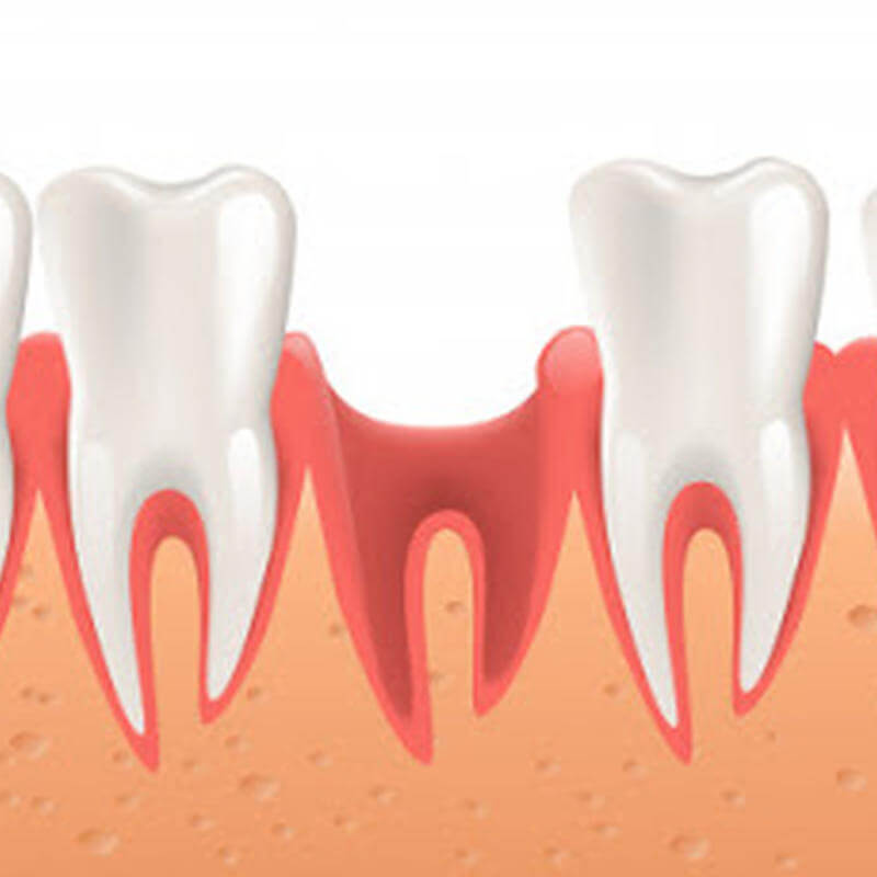 O que a perda de um ou mais dentes pode causar?