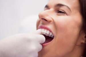 Dentista com luvas brancas encaixando alinhador invisível transparente nos dentes superiores de uma paciente na Clínica Cuidalli, focando na saúde bucal.