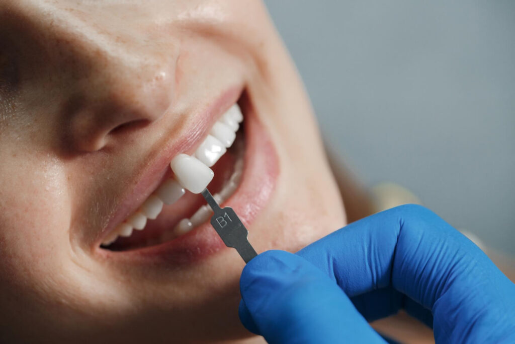 Dentista usa escala de cor para planejar o tom ideal de facetas de porcelana e evitar desgaste excessivo do dente na Saúde.